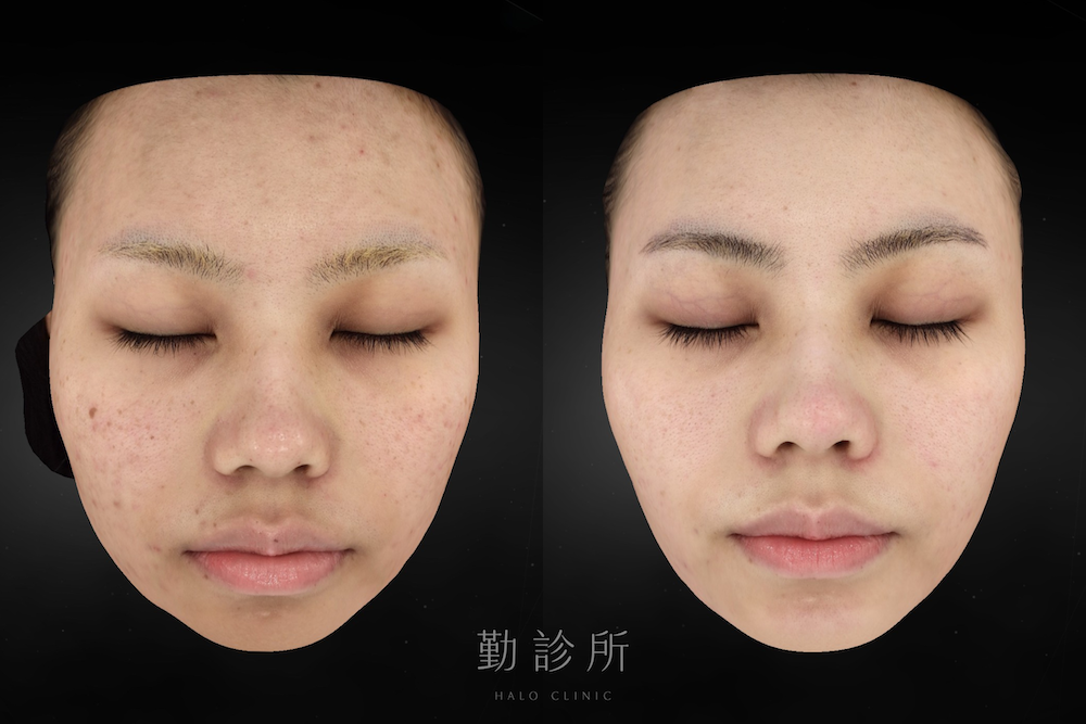 勤診所｜光電雷射實際案例：裸光肌雙雷射 正面