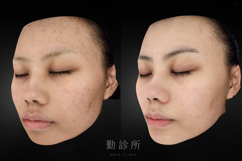 勤診所｜光電雷射實際案例：裸光肌雙雷射 左臉