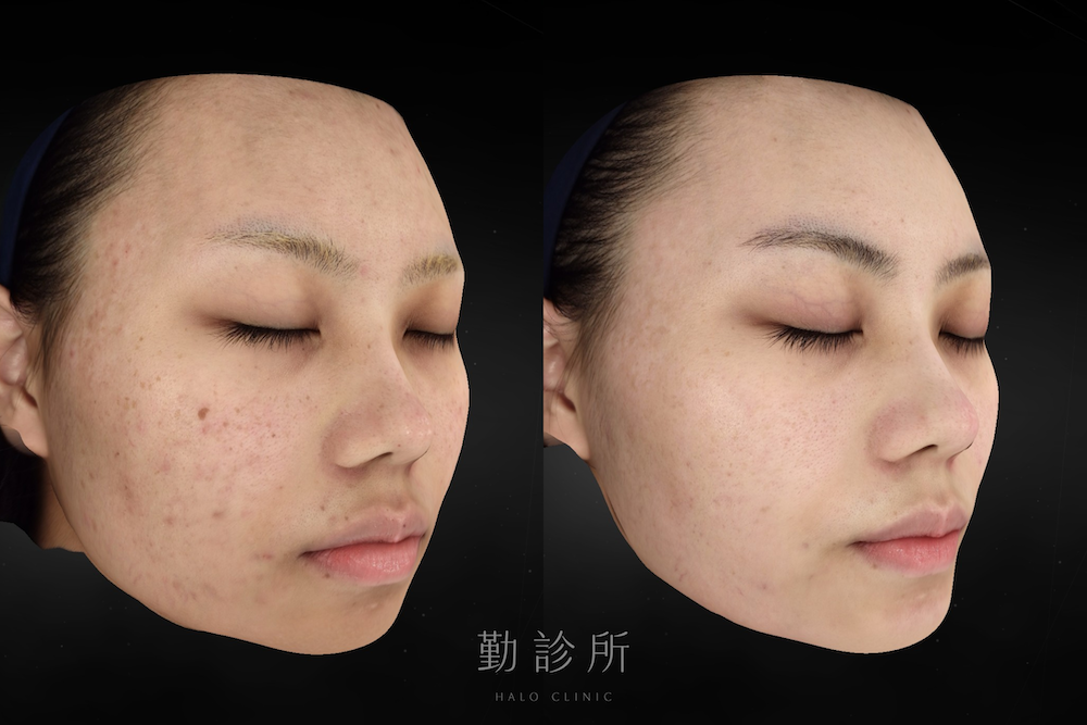 勤診所｜光電雷射實際案例：裸光肌雙雷射 右臉