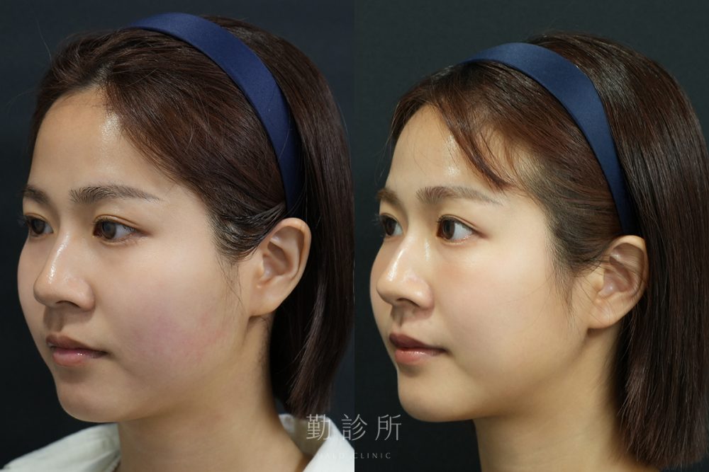 勤診所｜音波拉提真實案例：閃電音波拉提＋三層式淚溝隱形 左臉