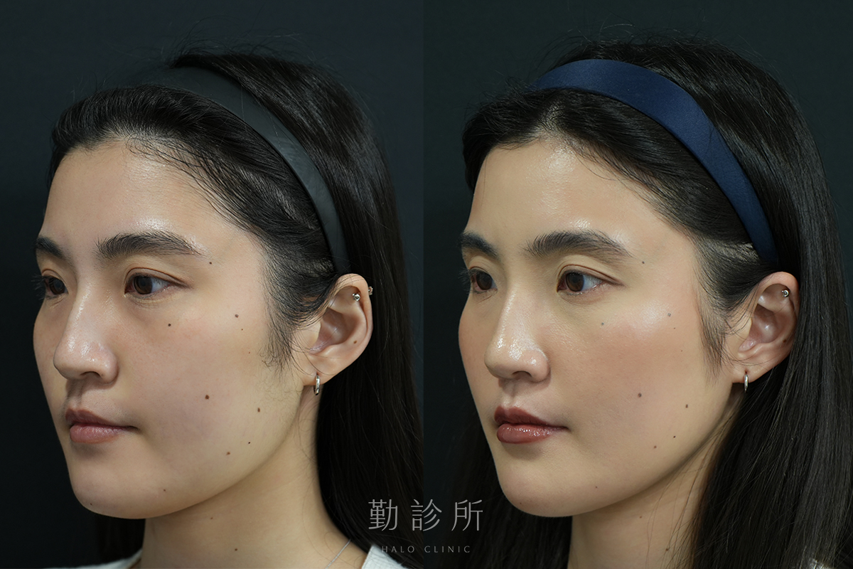 勤診所｜鼻基底填充案例：仙女玻尿酸＋玻尿酸豐唇＋肉毒瘦小臉 左臉
