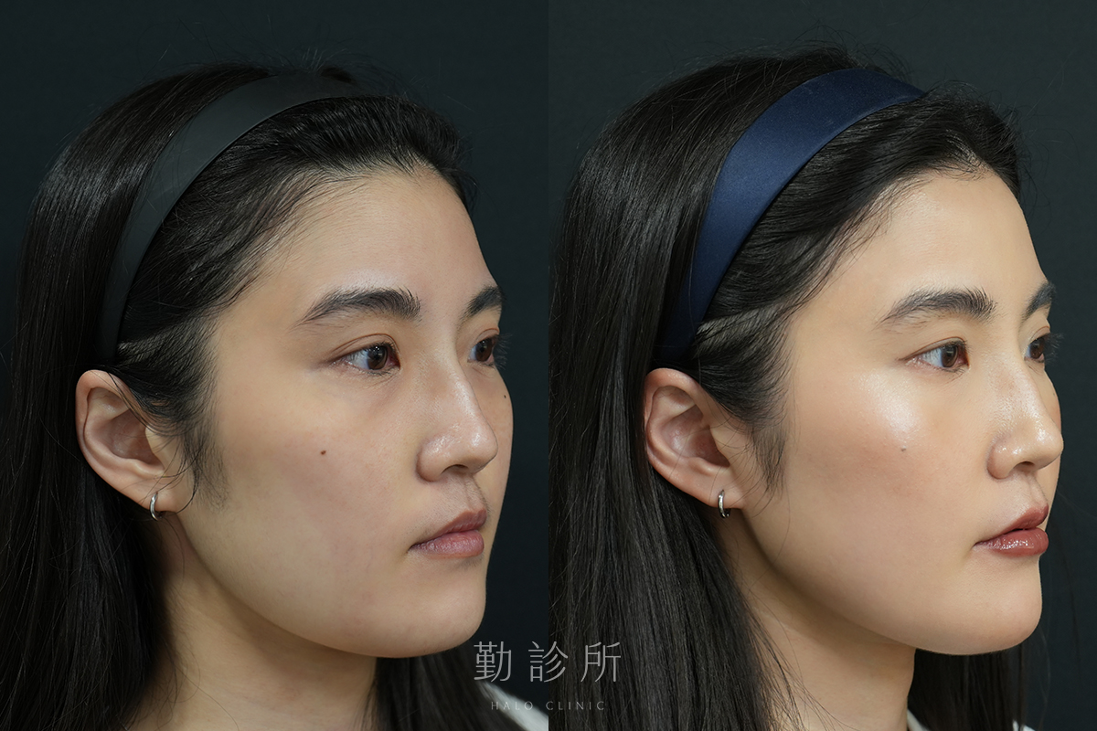 勤診所｜肉毒注射真實案例：肉毒小臉＋海芙音波 右臉