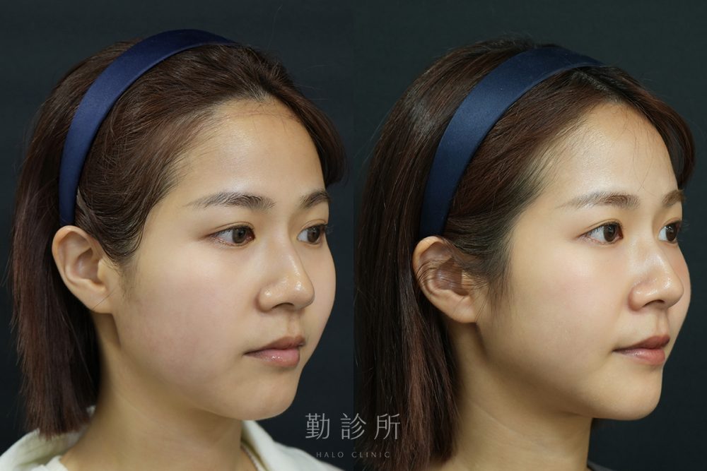 勤診所｜音波拉提真實案例：閃電音波拉提＋三層式淚溝隱形 右臉