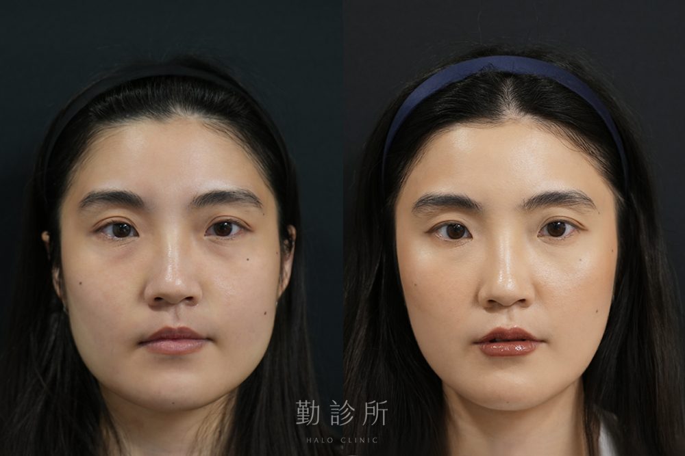 勤診所｜肉毒注射真實案例：肉毒小臉＋海芙音波 正面