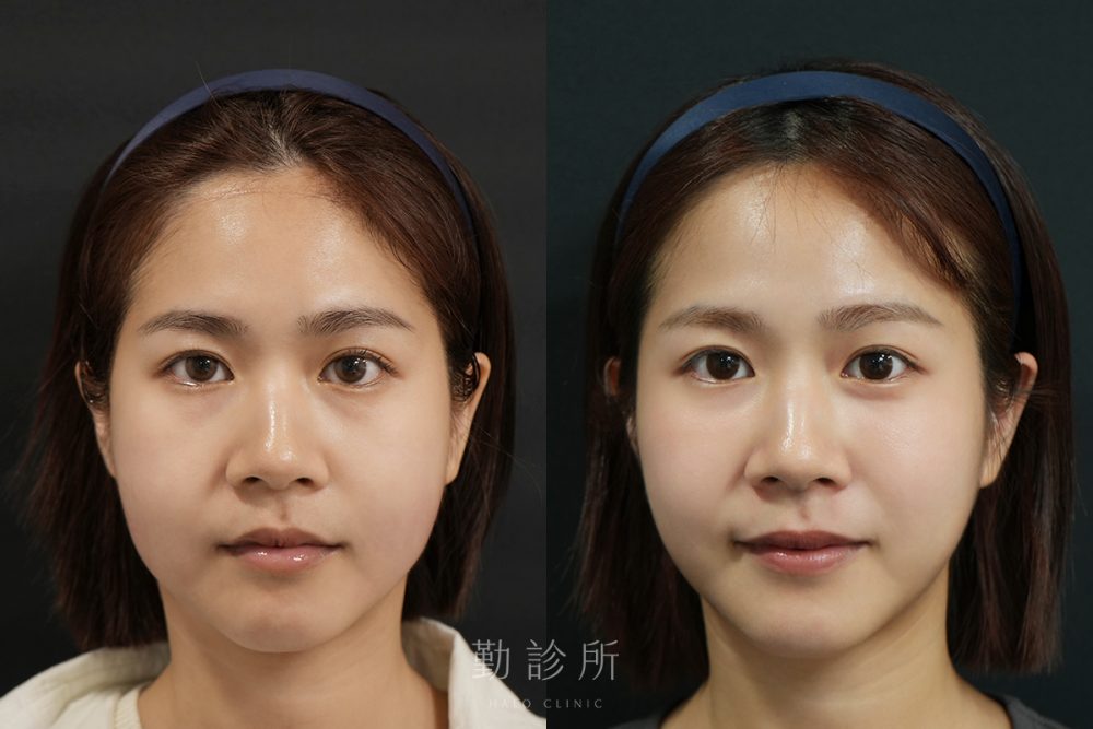 勤診所｜音波拉提真實案例：閃電音波拉提＋三層式淚溝隱形 正臉