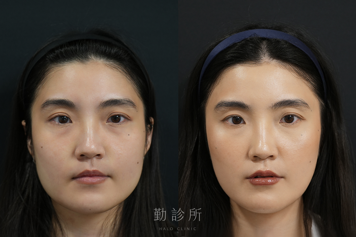 勤診所｜鼻基底填充案例：仙女玻尿酸＋玻尿酸豐唇＋肉毒瘦小臉 正面