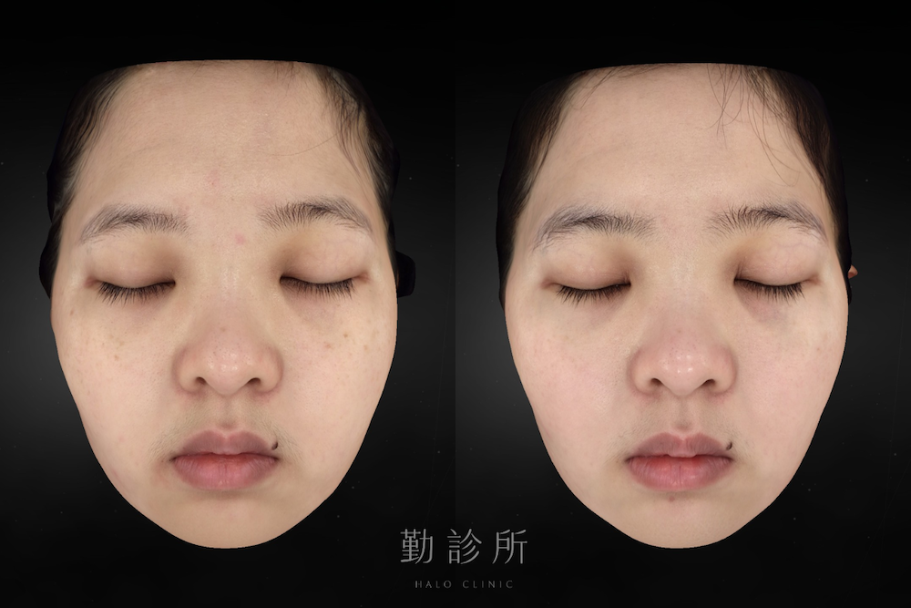 勤診所｜光電雷射實際案例：皮秒蜂巢 正面