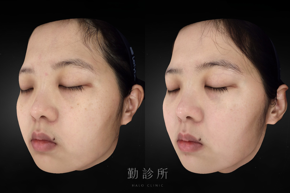 勤診所｜光電雷射實際案例：皮秒蜂巢 左臉
