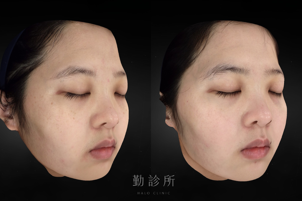 勤診所｜光電雷射實際案例：皮秒蜂巢 右臉