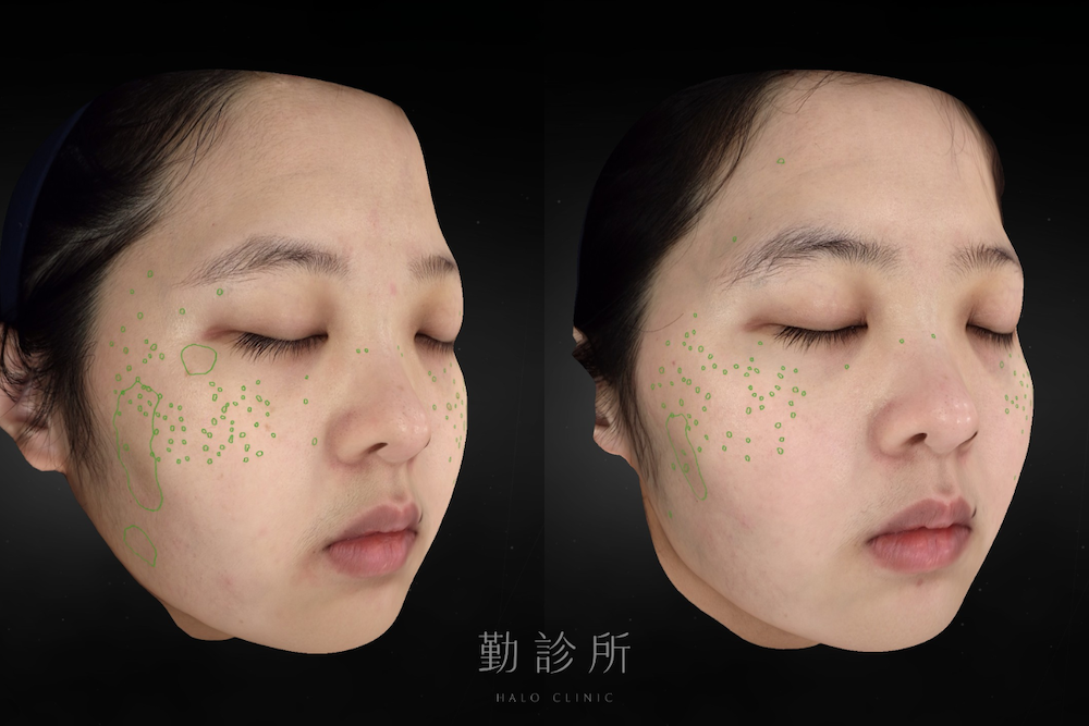 勤診所｜光電雷射實際案例：皮秒蜂巢 右臉