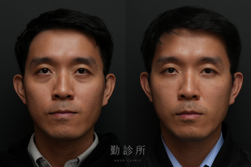 勤診所｜三層式淚溝隱形案例： 正面