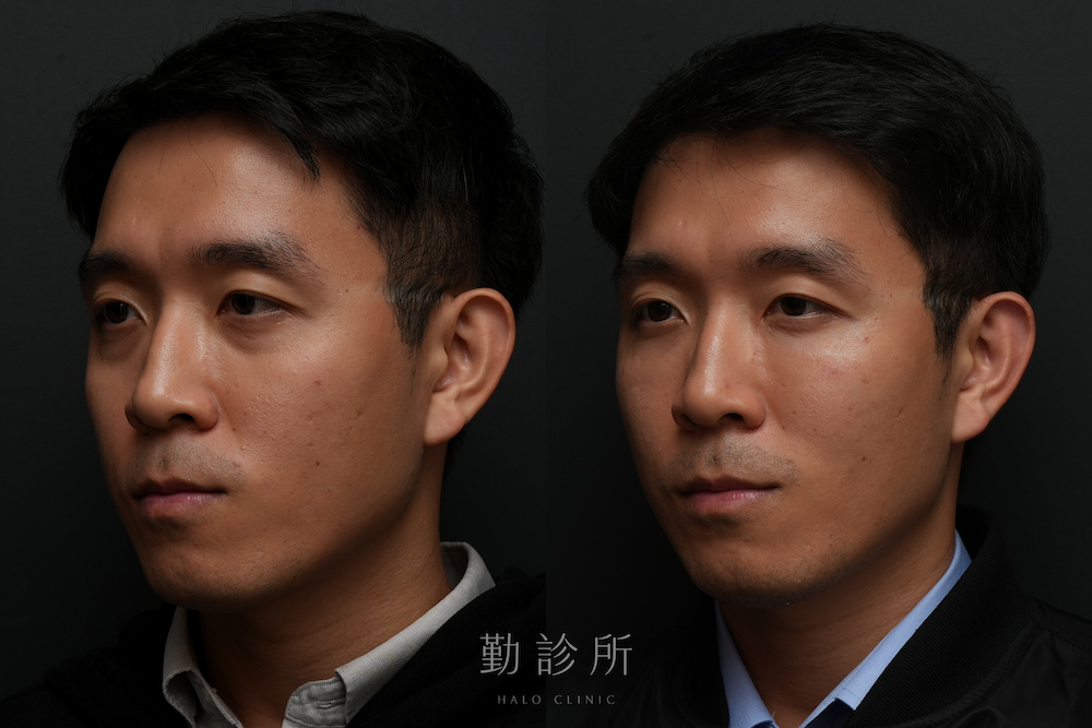 勤診所｜三層式淚溝隱形案例： 左臉