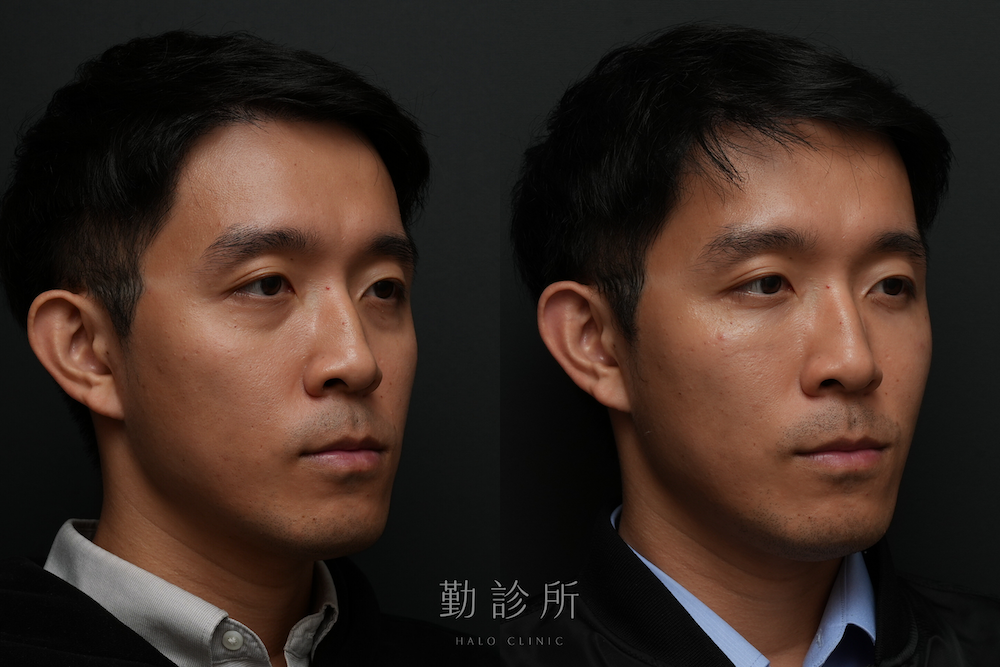 勤診所｜三層式淚溝隱形案例： 右臉