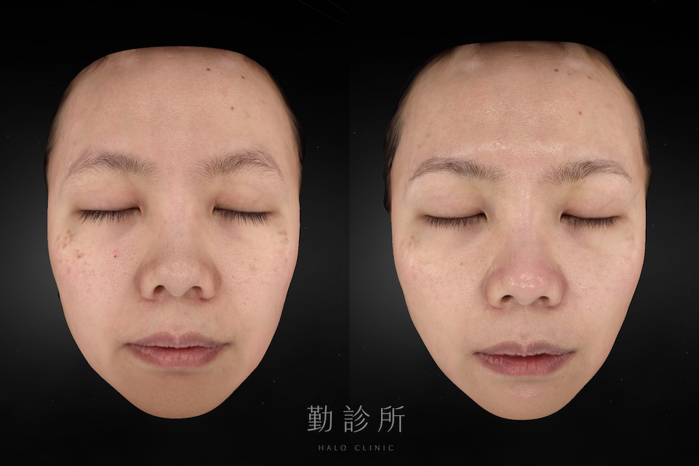 勤診所｜光電雷射實際案例：皮秒蜂巢 正面