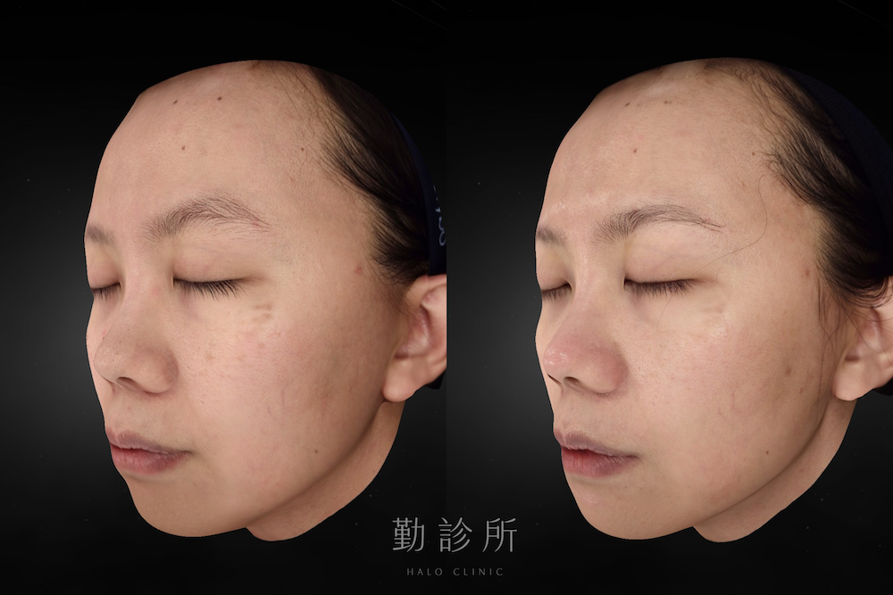 勤診所｜光電雷射實際案例：皮秒蜂巢 左臉