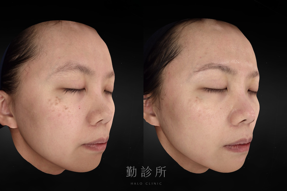 勤診所｜光電雷射實際案例：皮秒蜂巢 右臉
