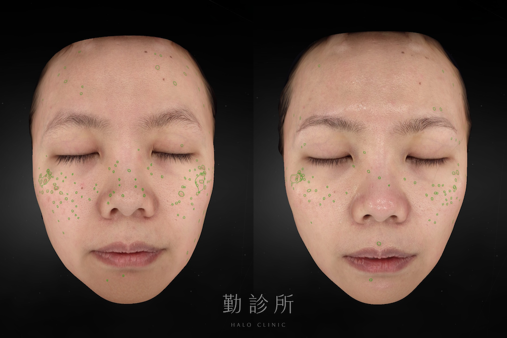 勤診所｜光電雷射實際案例：皮秒蜂巢 正面