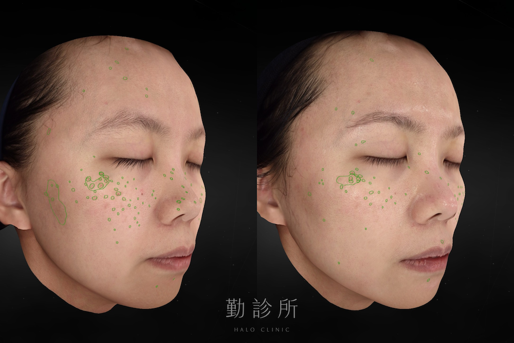 勤診所｜光電雷射實際案例：皮秒蜂巢 右臉