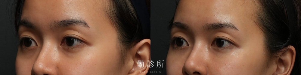 勤診所｜三層式淚溝隱形案例： 左臉