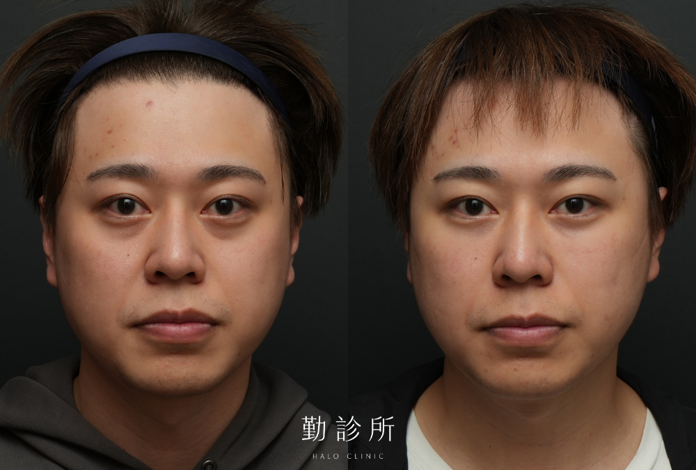 勤診所真實案例｜三層式淚溝隱形 正面