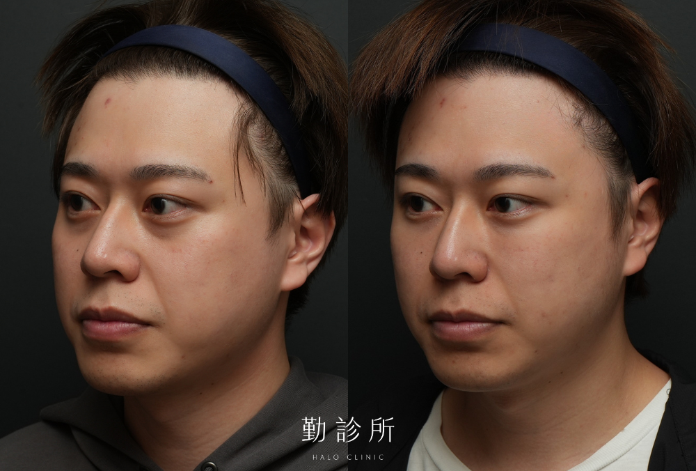 勤診所真實案例｜三層式淚溝隱形 左臉