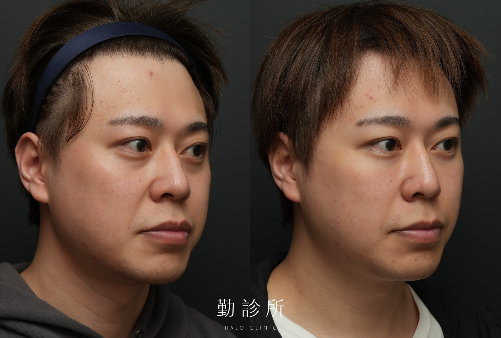 勤診所真實案例｜三層式淚溝隱形 右臉