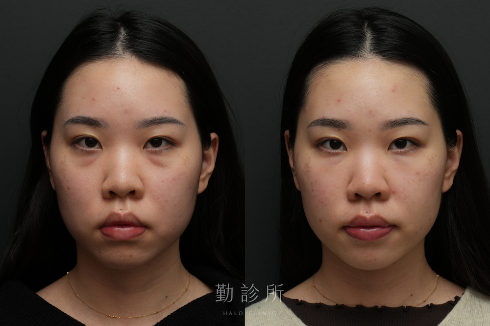 勤診所｜三層式淚溝隱形案例： 正面