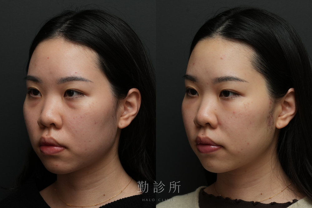 勤診所｜三層式淚溝隱形案例： 左臉