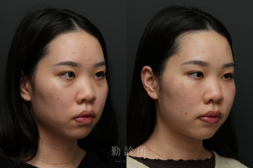 勤診所｜三層式淚溝隱形案例： 右臉