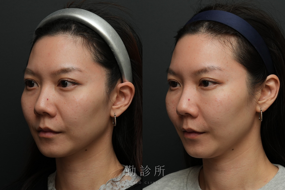 勤診所｜三層式淚溝隱形案例： 左臉