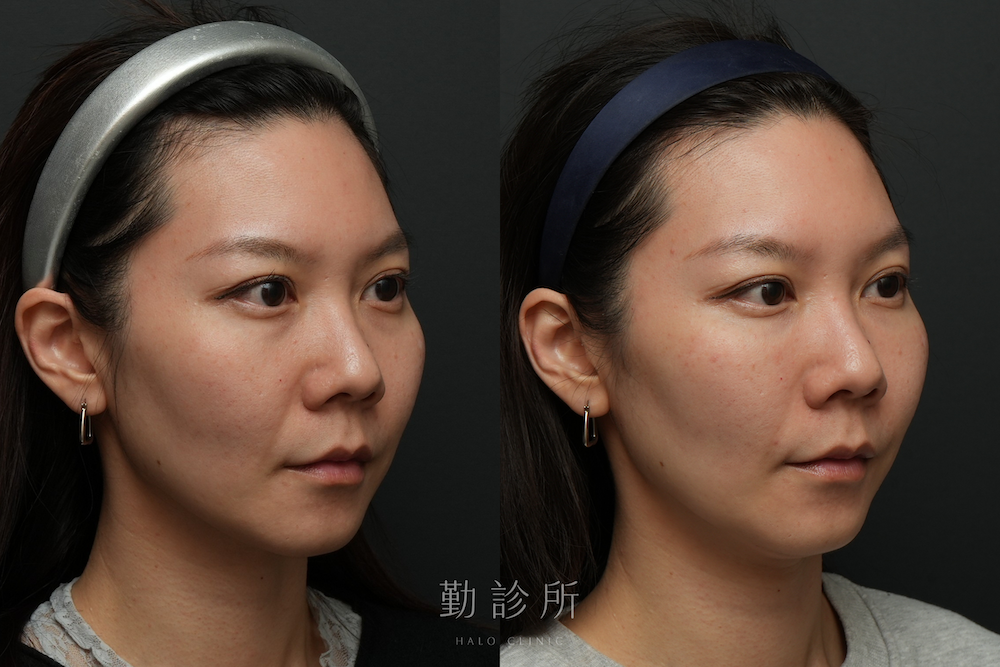 勤診所｜三層式淚溝隱形案例： 右臉