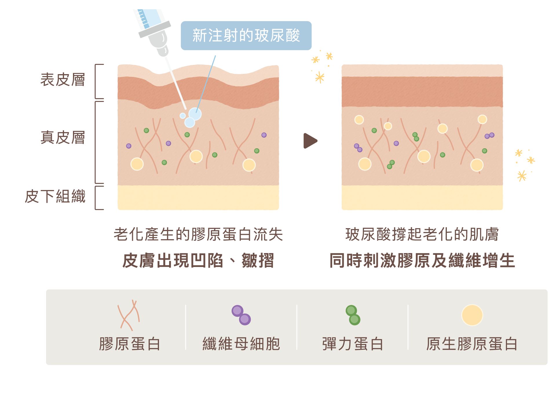 2603 瑞斯朗_美光針 拆圖01