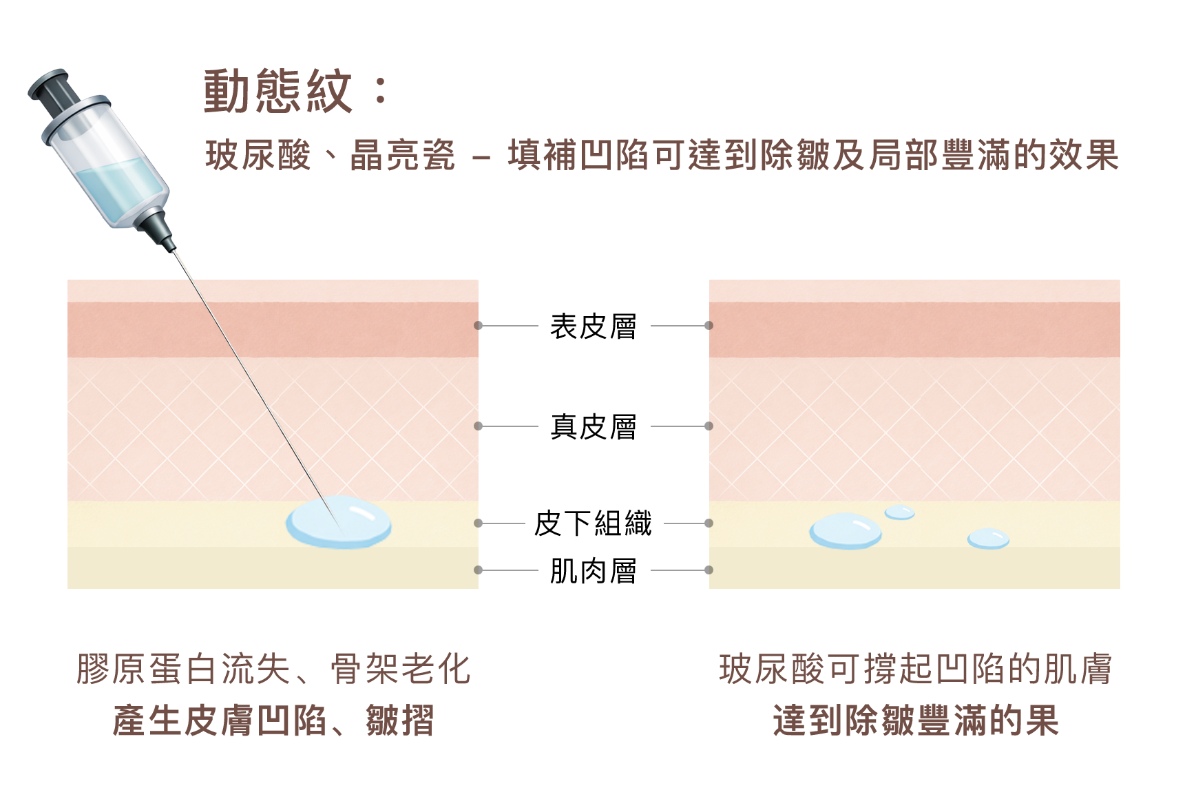 醫美玻尿酸填充劑與保養品玻尿酸的差異