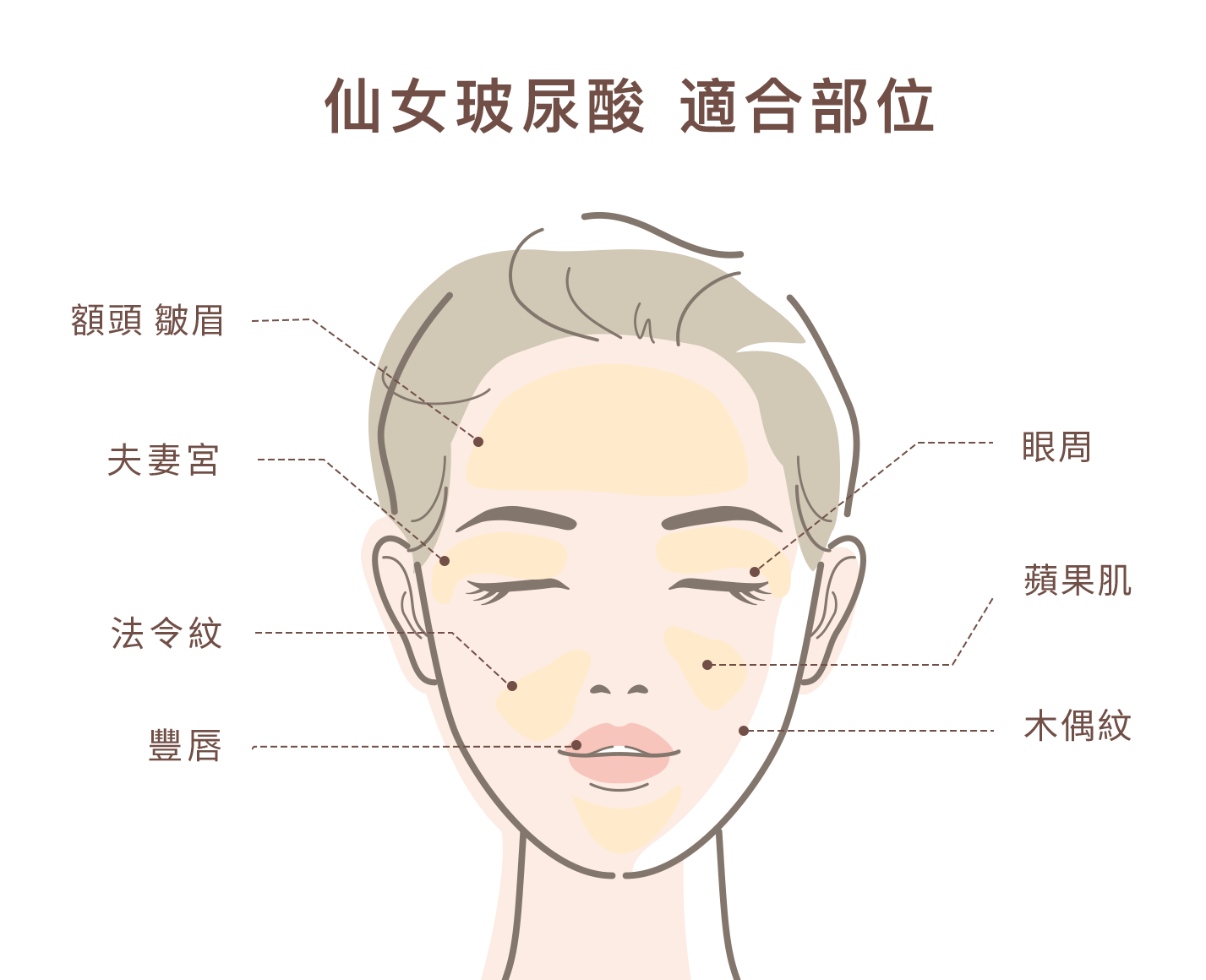 仙女玻尿酸適合部位