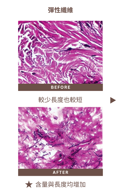 探索皮秒｜治療後膠原蛋白改變組織切片＿彈性纖維