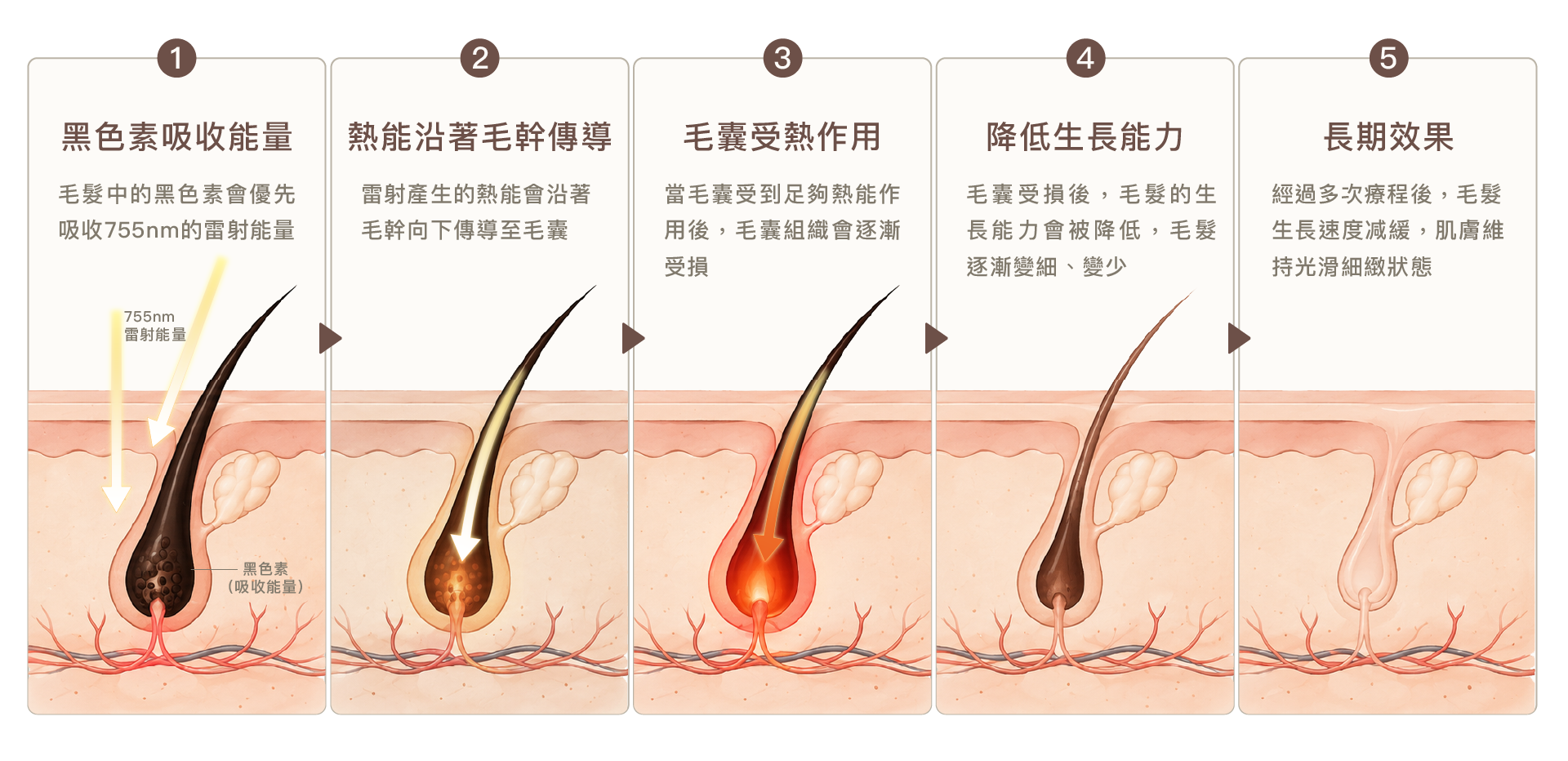亞歷山大除毛原理